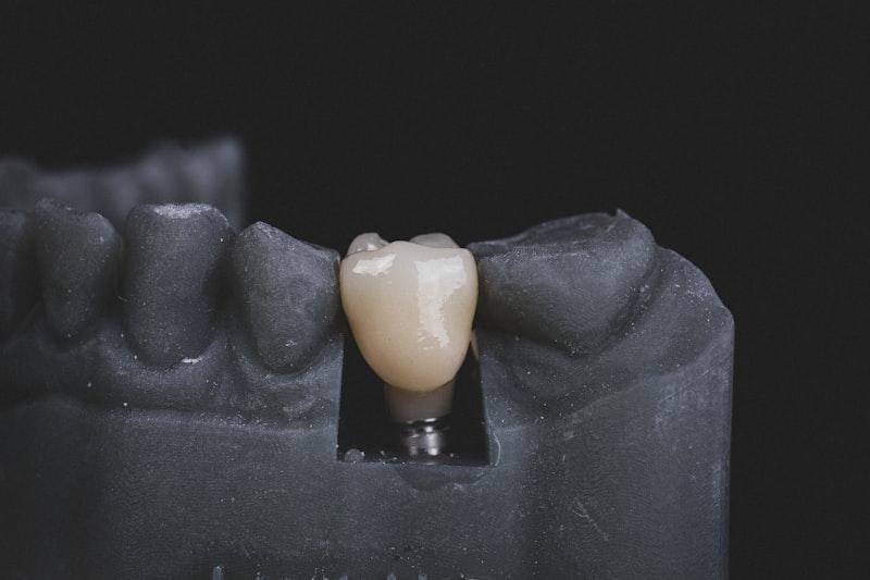 Tratamiento de Implantes Dentales / Rehabilitación Funcional en Renova Dental